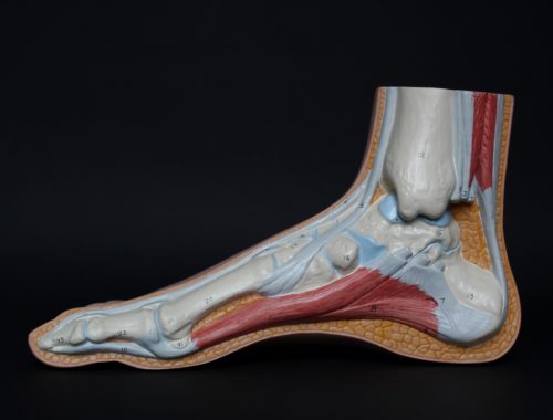 Achilles Tendinitis